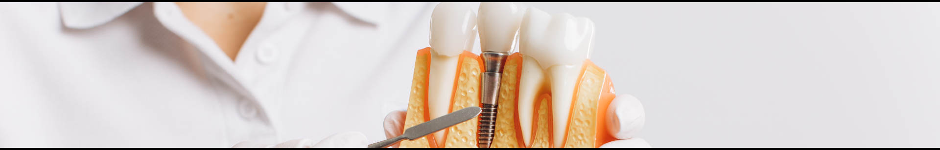 Implant dentaire